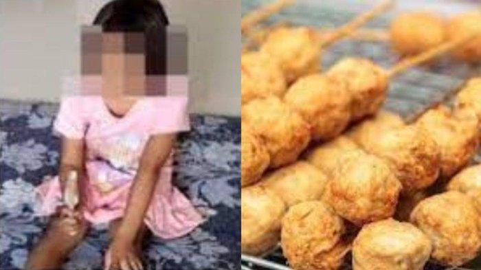 Siswi SD berinisial SAH (8) mengalami kebutaan usai dicolok menggunakan tusuk bakso [tribunnews]