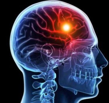 Ilustrasi stroke [labcito]